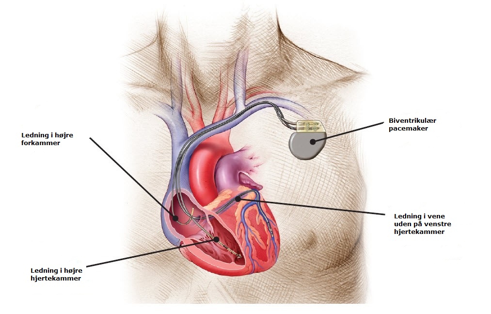 Pacemaker